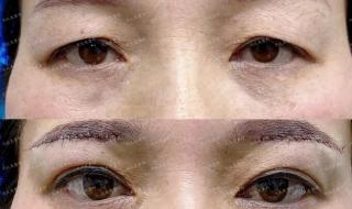 筋膜悬吊和筋膜提升一样吗